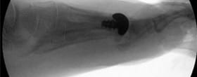 knee replacement alternatives