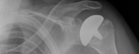 knee replacement