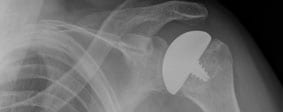 stemless total shoulder