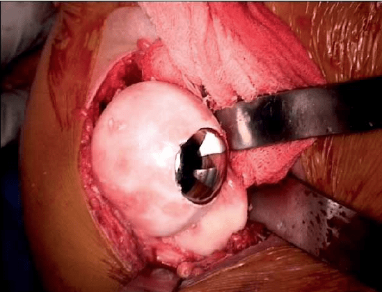 shoulder implant surgery