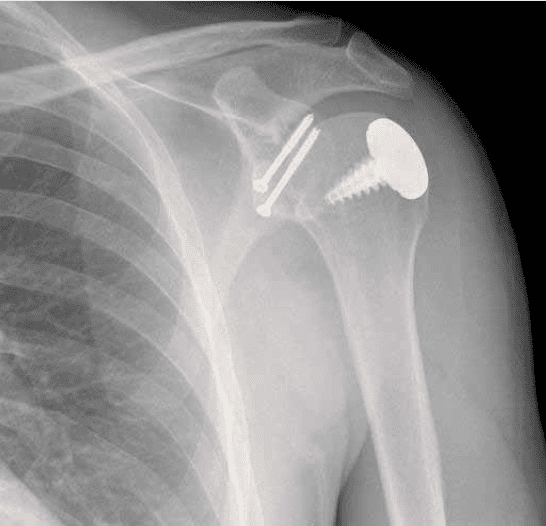 shoulder joint pain
