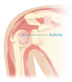 shoulder replacement
