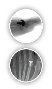 foot pain relief