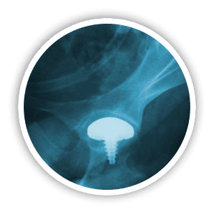hip replacement