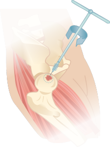 hip replacement surgery