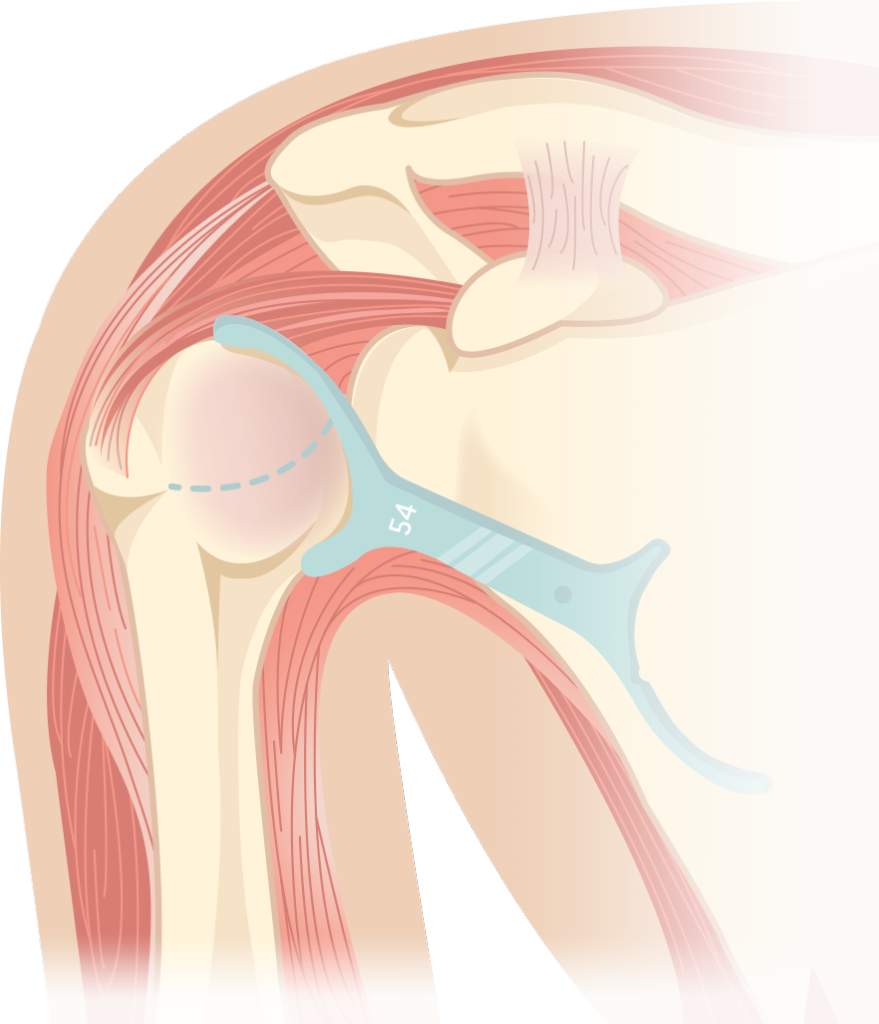 knee replacement
