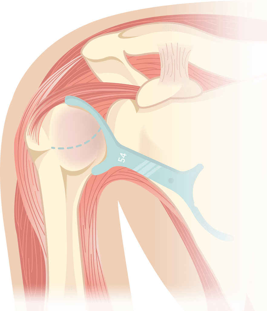 shoulder surgery