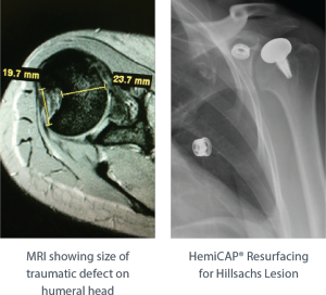 shoulder implant surgery