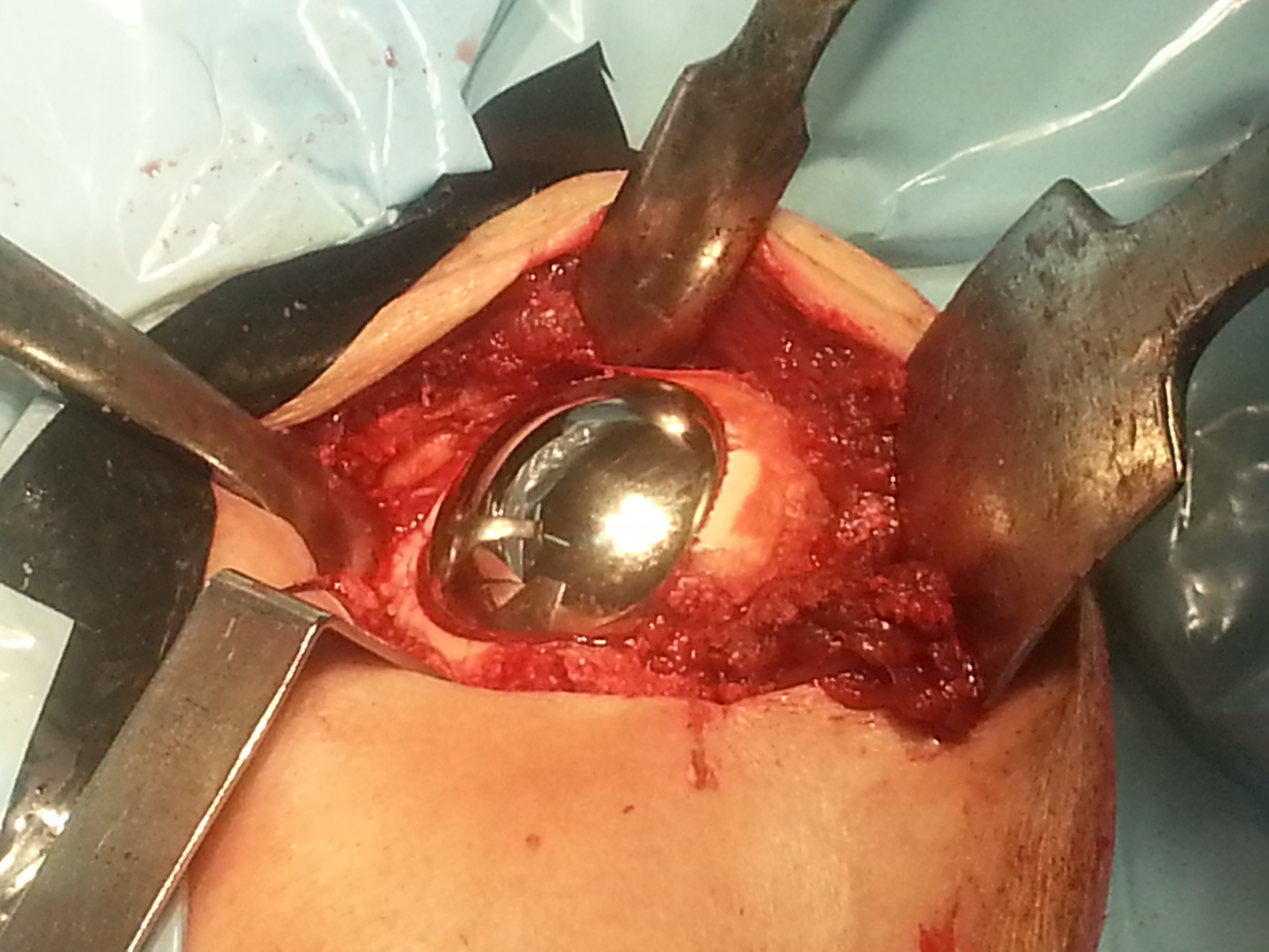 Alternatives to Shoulder Replacement