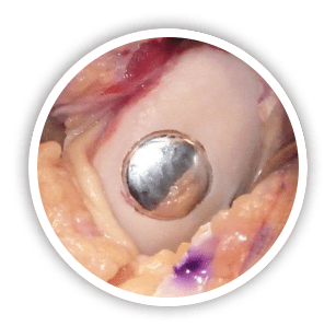 knee replacement options total knee replacement
