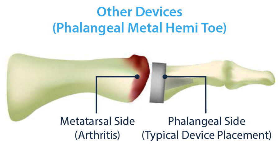 toe joint surgery