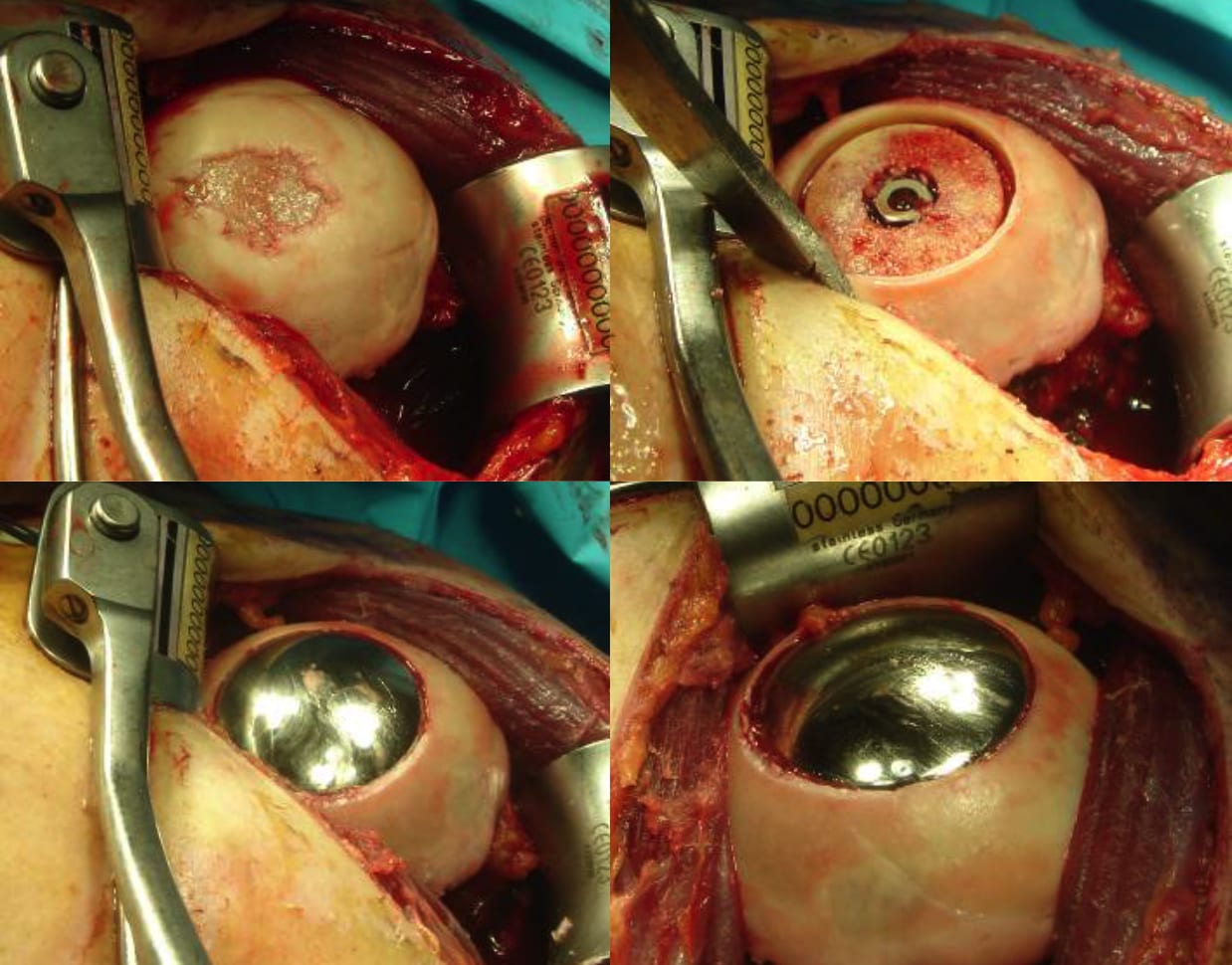 Alternative to shoulder replacement surgery