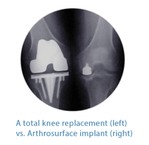 knee injuries