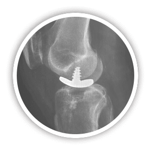 rotator cuff pain