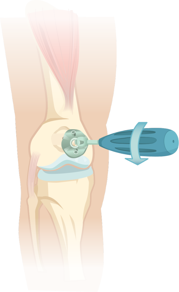meniscus tear