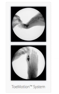 total knee replacement
