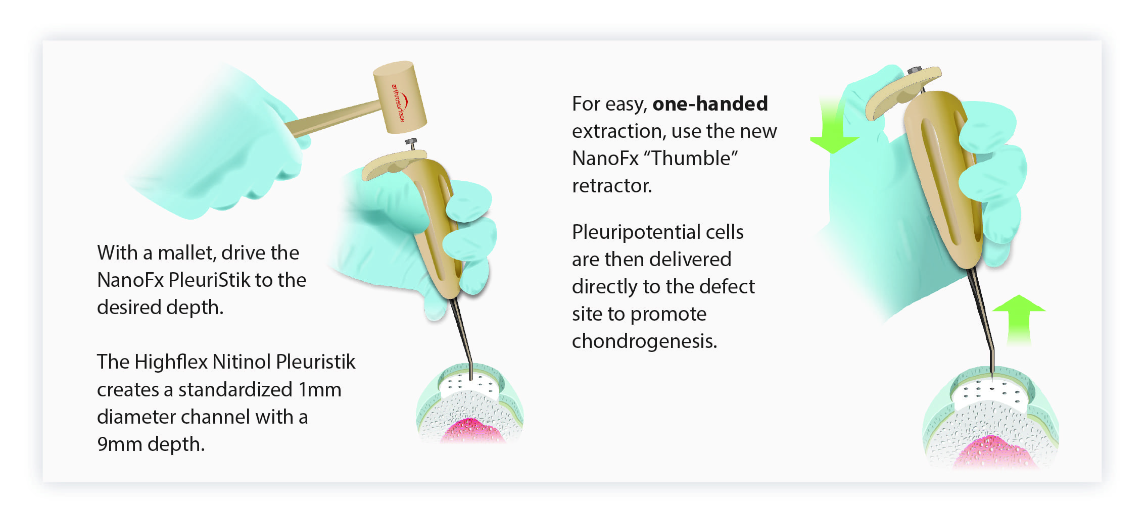 alternative to wrist fusion