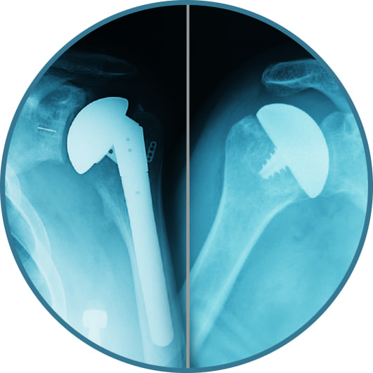 shoulder implants
