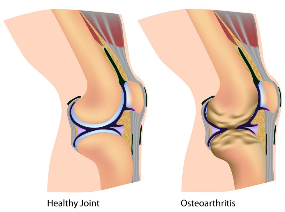 a study on the cause and treatment of knee osteoarthritis a study on the cause and treatment of knee osteoarthritis