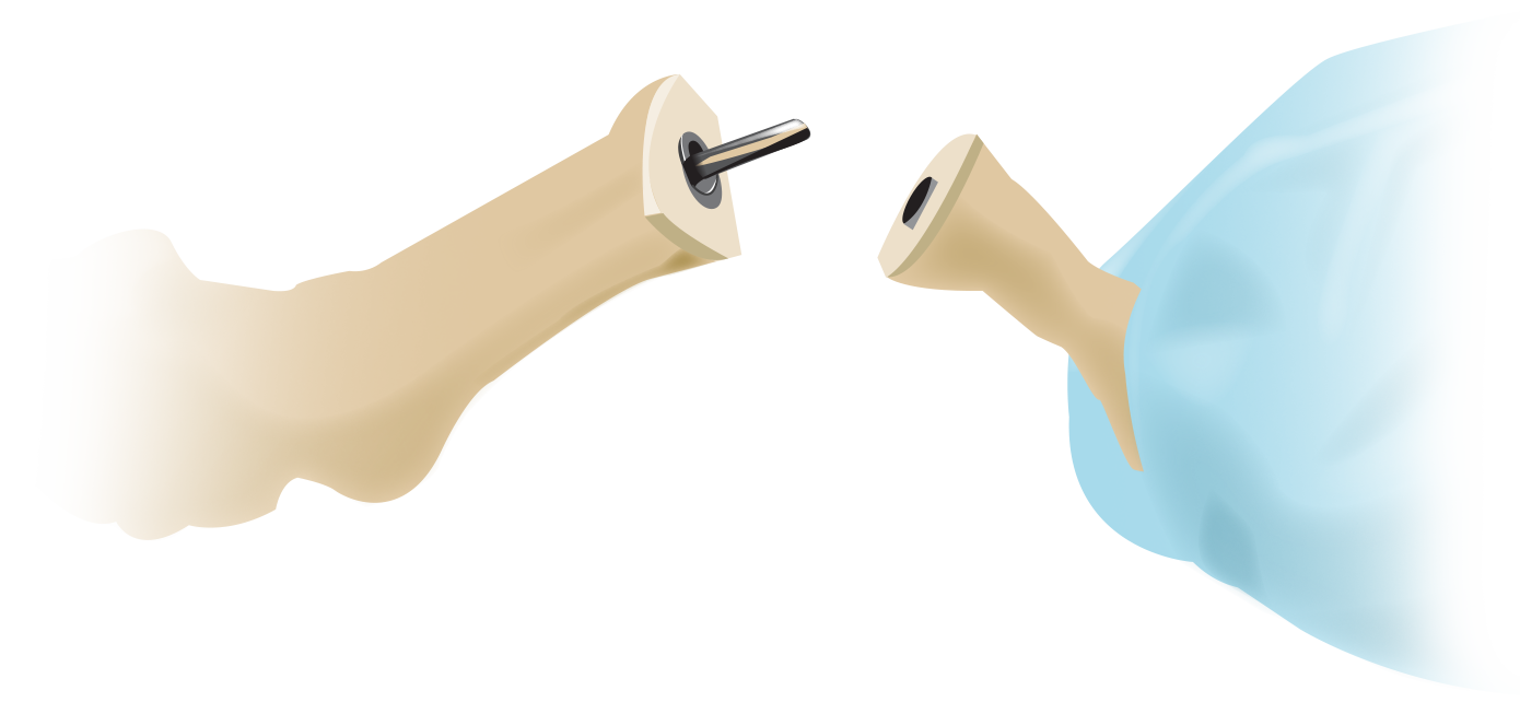 hammertoe surgery