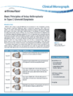 Type C Glenoid - Clinical Monograph