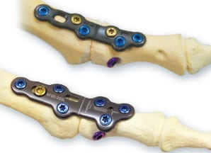 toe fusion alternatives
