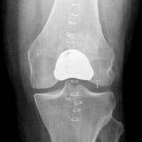 knee joint