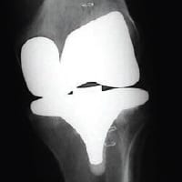 knee implants