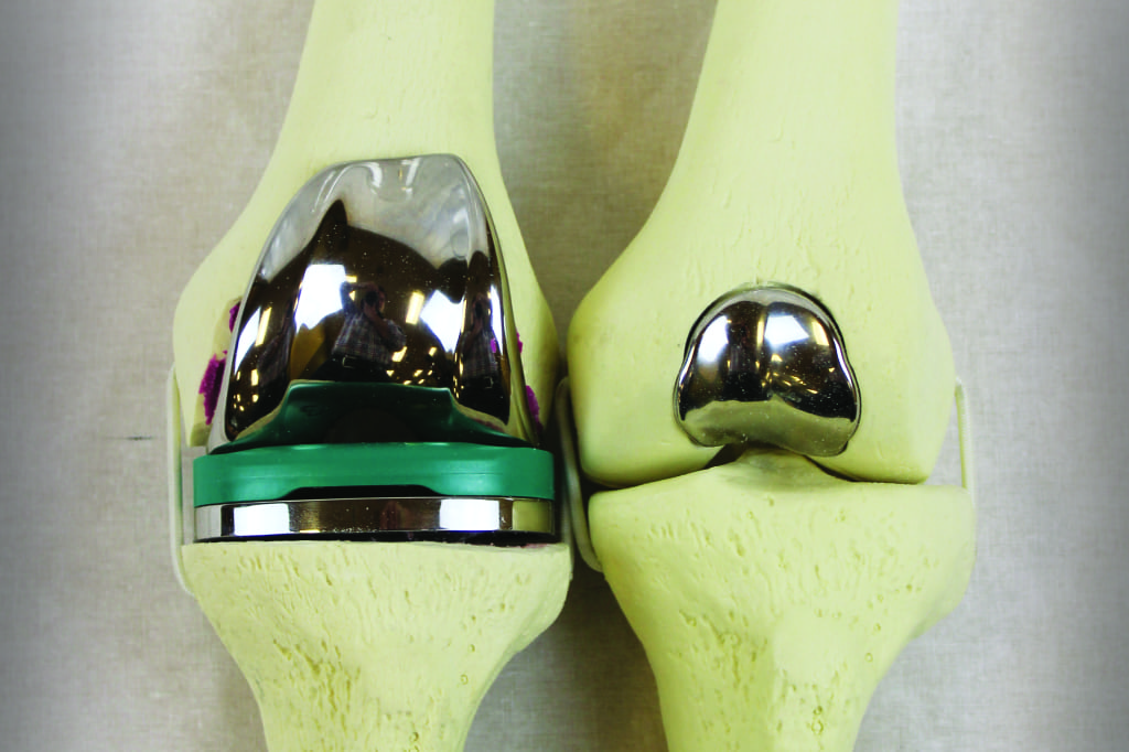 Knee Replacement Alternatives Knee Joint