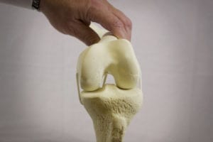 knee replacement