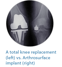 knee replacement