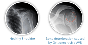 shoulder replacement surgery