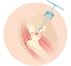 hip replacement