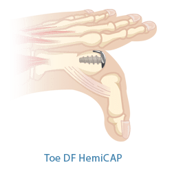 toe implant