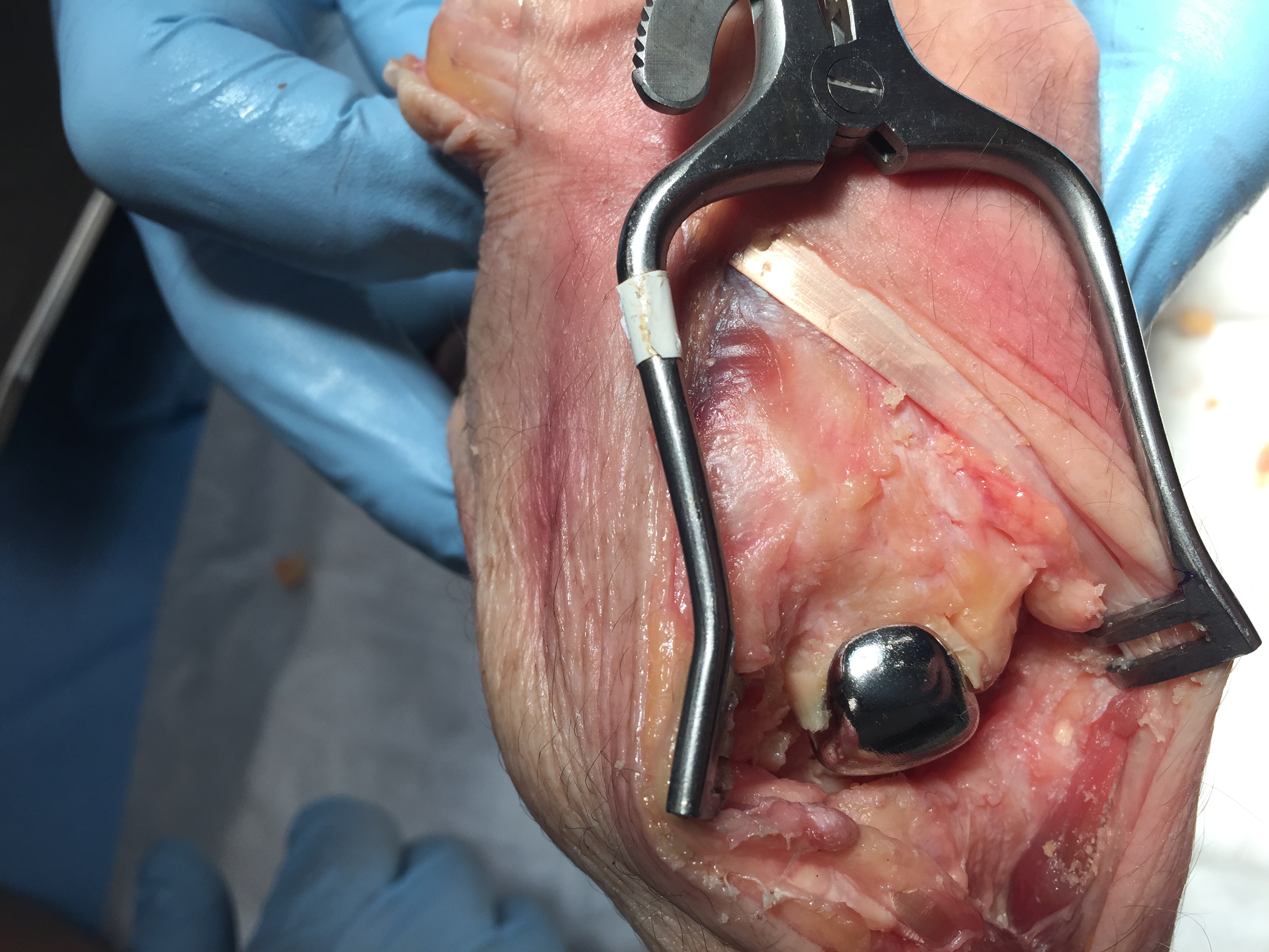 Wrist Implants SLAC and SNAC Wrists Surgery Options Wrist Implants SLAC and SNAC Wrists Surgery Options