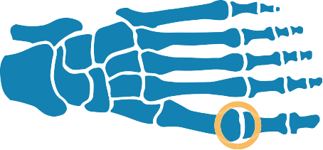 toe joint pain