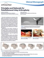PF Inlay Arthroplasty Clinical Monograph