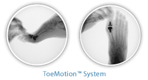 Toe Motion