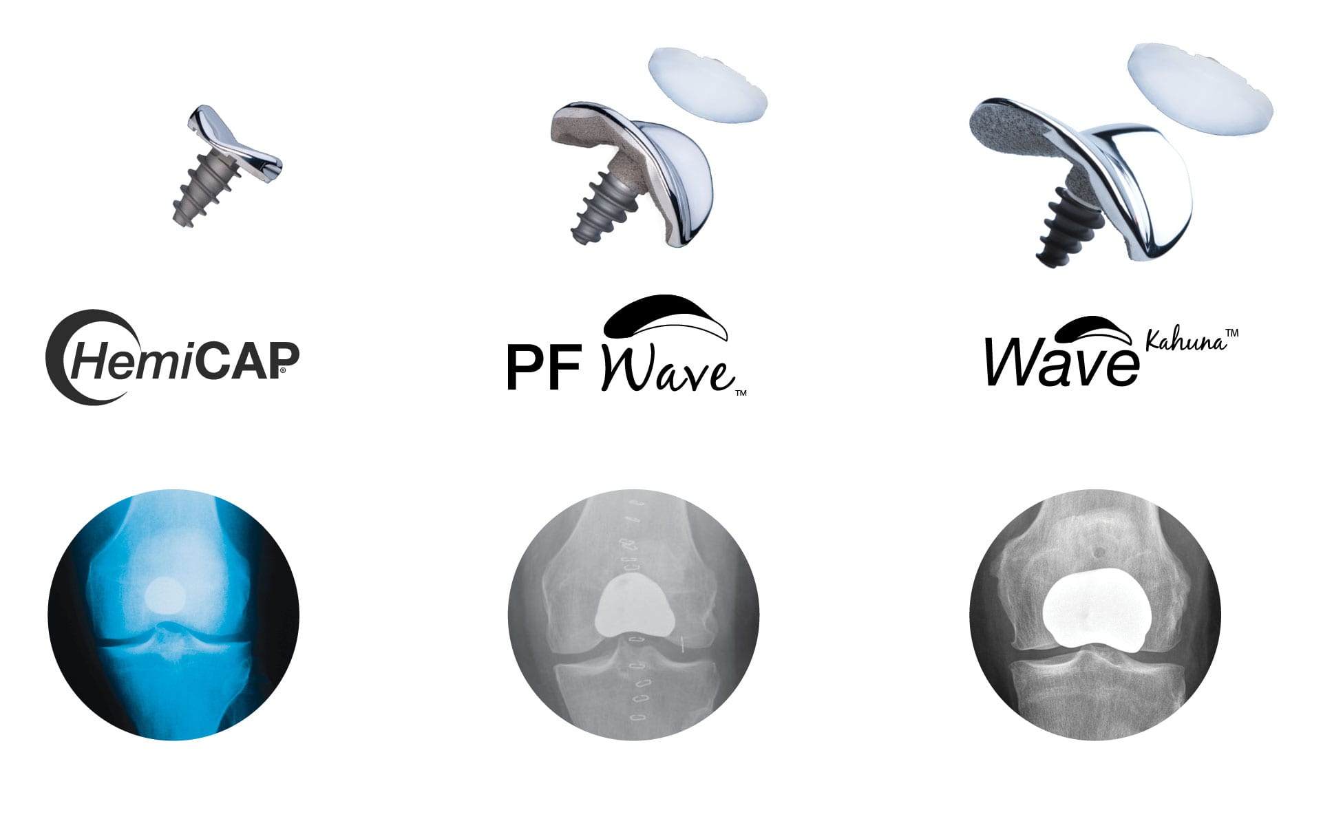 Knee Implants
