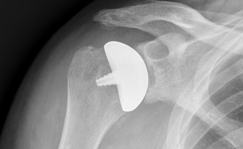 shoulder arthroplasty system