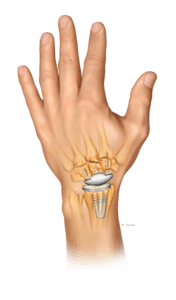 Total Wrist Replacement